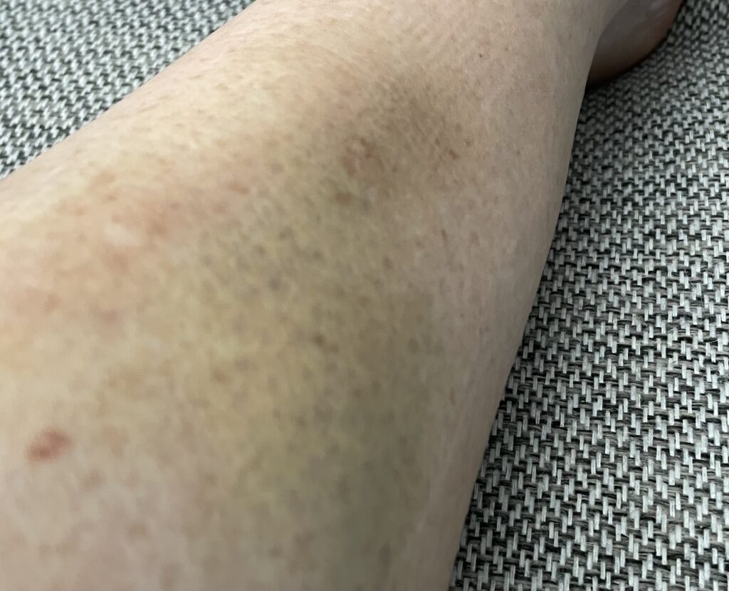 Photograph showing bruising on my leg after the first incident of physical abuse.