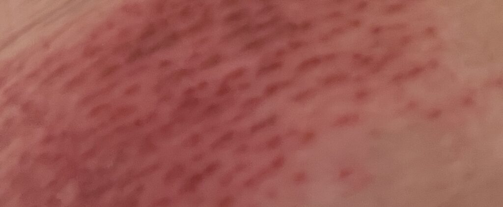 Close-up photograph of red abrasions on my skin after I was dragged during an abusive incident.