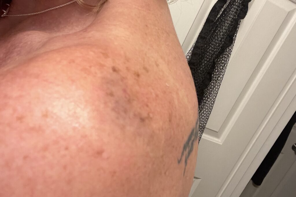 Photograph showing bruising on my shoulder after an incident of physical abuse.