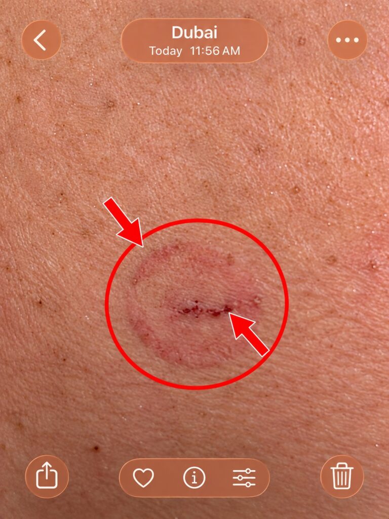 Close-up of camel bite injury in Dubai showing broken skin, a horizontal wound and circular bruising outlined in red.