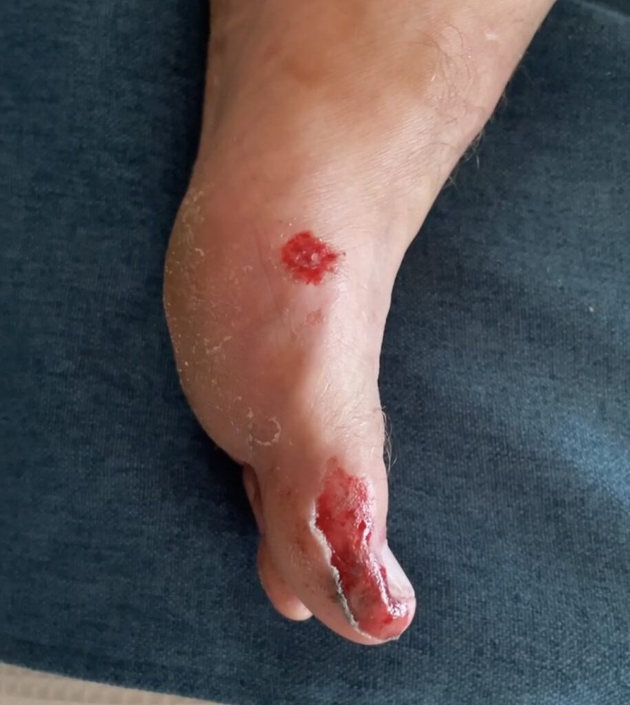 My partner's injured foot with cuts and abrasions after he crashed a scooter while driving in Turks and Caicos.